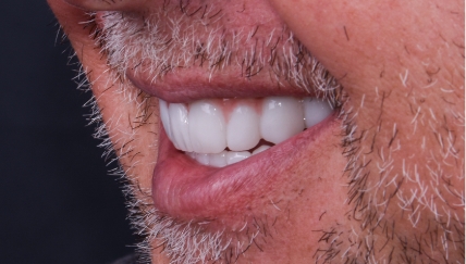 Get Your Smile Back with All on 4 Dental Implants: A Two-Trip Solution in Cancun, Mexico