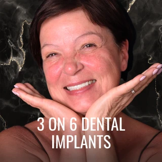 patient smiling after 3 on 6 dental implants treatment at A1 Smile Design Playa del Carmen