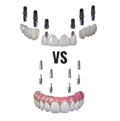 diffences between 3-on-6 versus All-on-4 dentures and implants