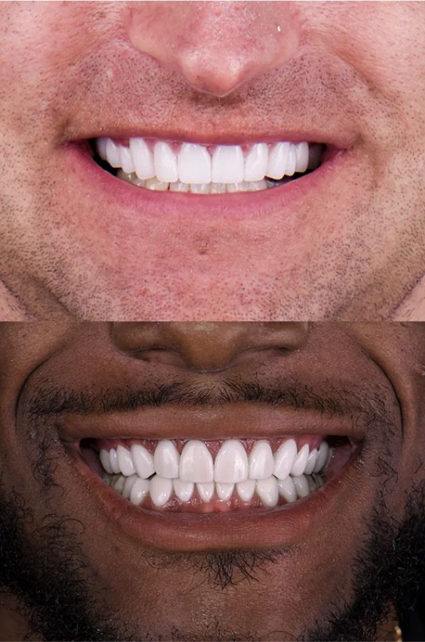 Side-by-side comparison of porcelain veneers vs composite veneers