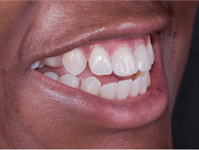 before treatment close-up of her teeth