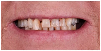A testimonial image from a patient at A1 Smile Design