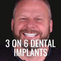 go to 3 on 6 dental implants page