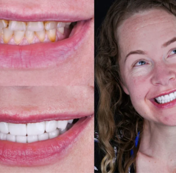 before and after treatment close-up shots of a patient teeths