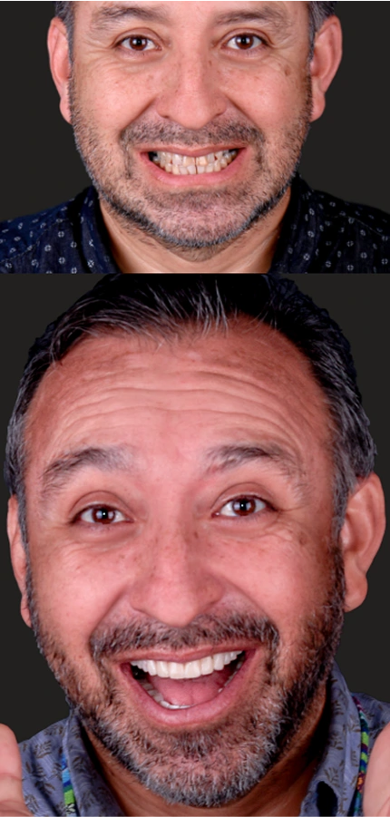 A gallery of before-and-after photos showcasing the results of dental crowns.