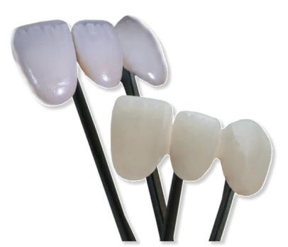 2 dental crowns bridges of zirconia and Emax porcelain