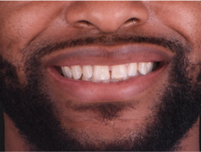 A before image of a patient's teeth prior to getting dental crowns.