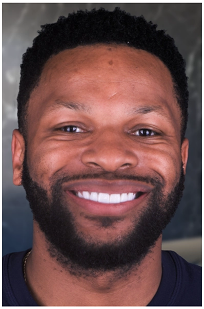 an after picture showing a patient's restored smile with dental crowns.