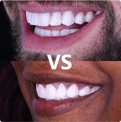  A side-by-side comparison of a dental crown and a veneer,