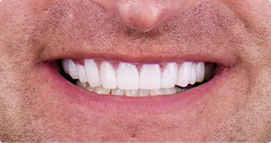 Before and after comparison of Lumineers smile transformation in Cancún.