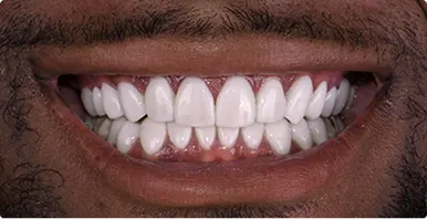 Before and after comparison of Lumineers smile transformation in Cancún.