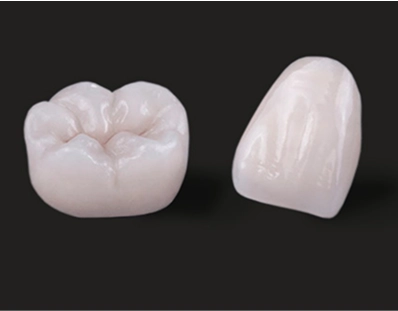 A close-up of an Emax porcelain crown being placed on a patient's tooth.