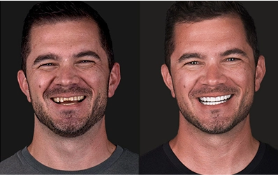 before-and-after photo of a patient with crowns