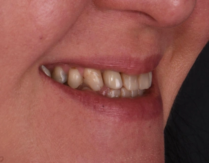 Female patient smiling after 10 Emax veneers, natural looking porcelain veneers, smile design results, cosmetic dentistry transformation, white balanced teeth