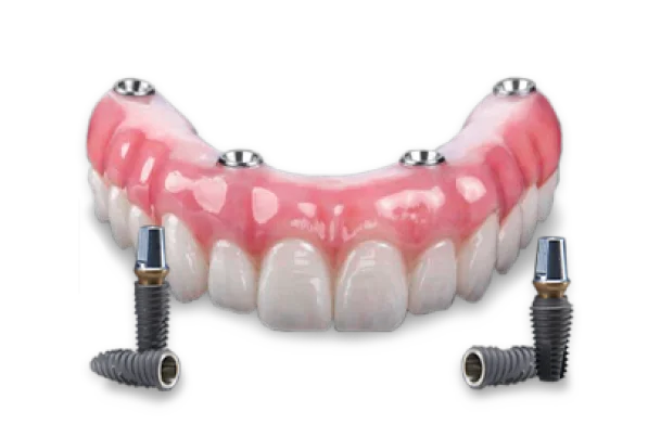 illustration of the superstructure of an all on 4 with regular implants