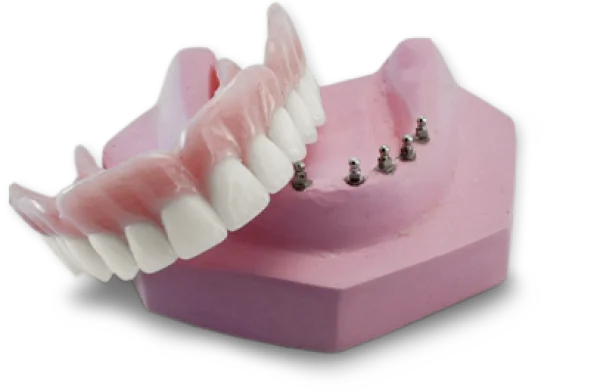 teeth model that shows the function of an snap-on denture