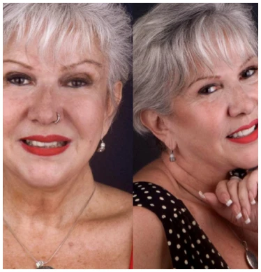 An image of a patient before and after getting snap-on dentures