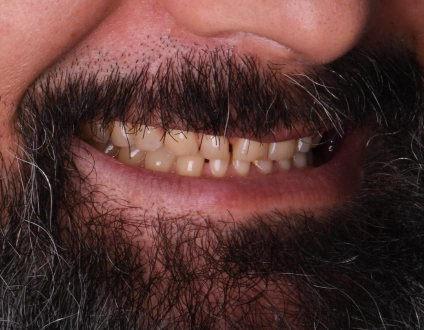 before smile makeover with stained and damaged teeth, candidate for porcelain veneers, cosmetic dentistry transformation case, dental veneers before treatment