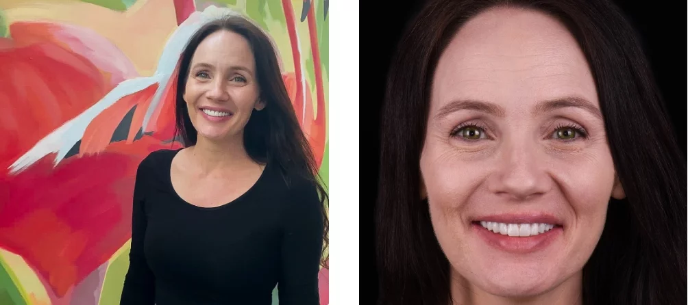 Smile transformation after all-on-4 treatment