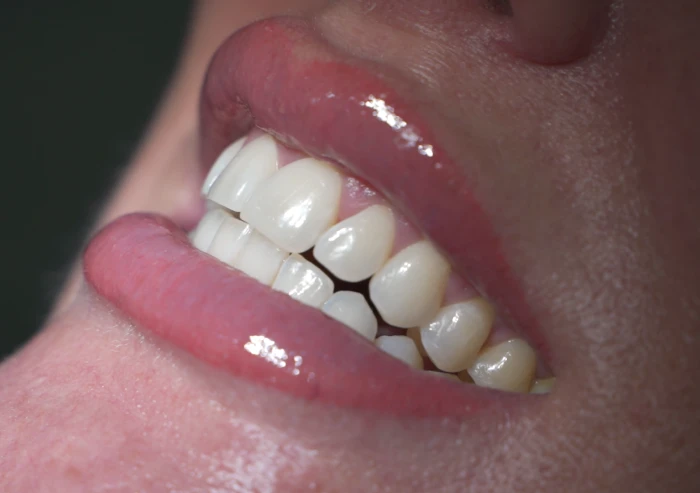 Healthy white smile after cosmetic dentistry in Playa del Carmen.