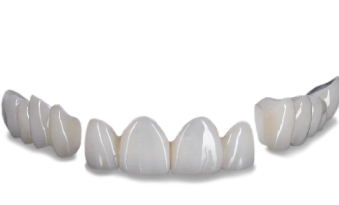 dental bridges for an 3-on-6 restoration