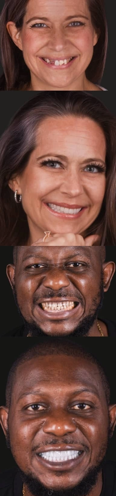 gallery of before and after photos of patients who got their treatments in a1 smile design