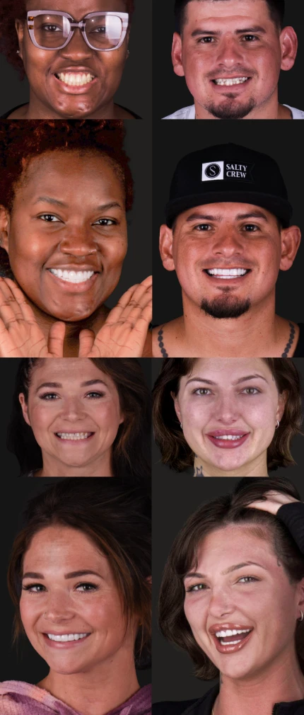 cosmetic dentistry before and after results in Mexico by A1 Smile Design