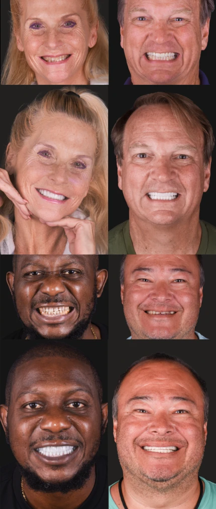 restorative dentistry before and after smiles at A1 Smile Design Playa del Carmen