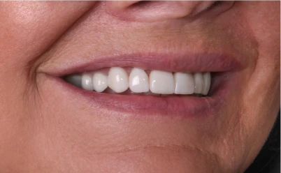 close up smile after dental crowns treatment in Playa del Carmen