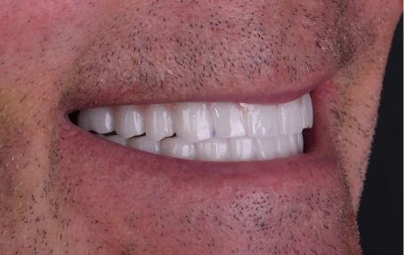 Smile result after dental implants treatment in Mexico