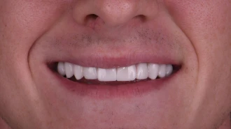 close up smile after full smile makeover in Playa del Carmen