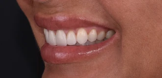 teeth close up showing veneers results in Mexico