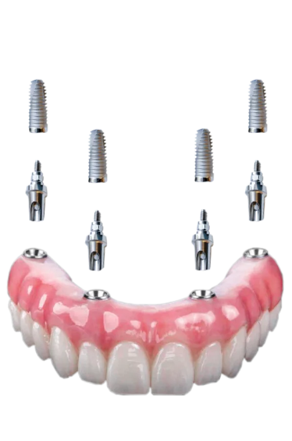 an exploded diagram of implants, abutments and denture used in all on 4 treatments
