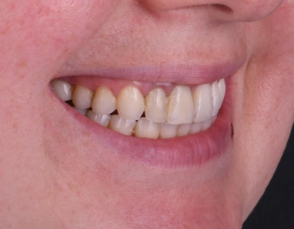 Before image of patient for 6 Emax Veneers, slightly misaligned teeth, cosmetic dentistry case, dental veneers preparation, smile enhancement treatment