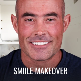 patient smiling after smile makeover treatment at A1 Smile Design