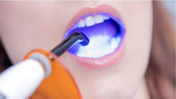 patient teeth under whitening laser