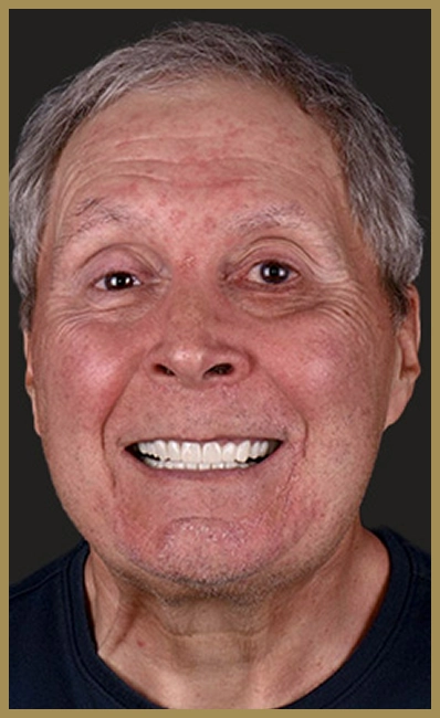 before and after shots showing crooked teeth turned into a bright smile