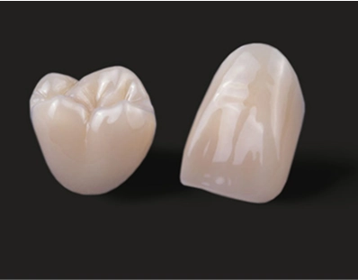 A close-up of a zirconia crown being placed on a patient's tooth.